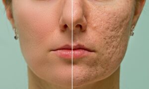 How to Get Rid of Acne Scars Fast