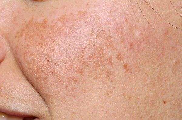 Laser Treatment for Melasma